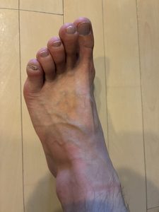 左足甲。小指の爪が小さい。